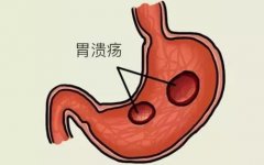 胃溃疡的症状有哪些?看杭州御和堂老中医在线解析!